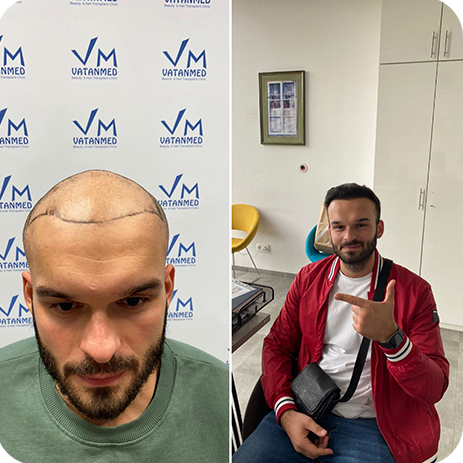 Šta Očekivati Tokom Oporavka Nakon Transplantacije Kose?